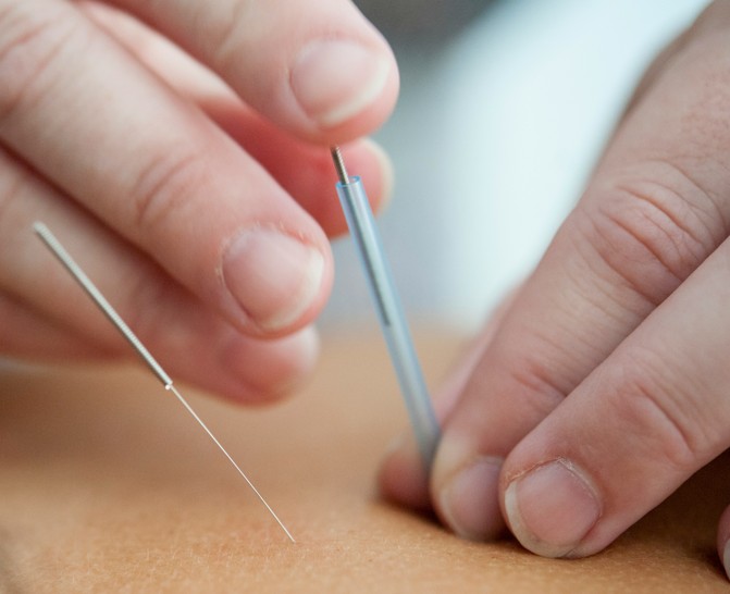 Akupunktio hoitotilanne neuloilla